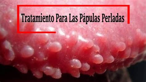 papulas perleadas|Pápulas perladas del pene